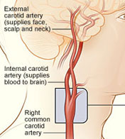 Image of Carotid Arteries