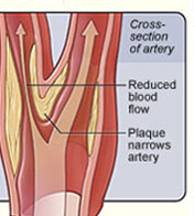 Image of plaque narrowing Carotid Arteries