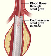 Image of Endovascular Stent & Blood Flowing