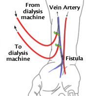 Is the AV fistula the best hemodialysis method?