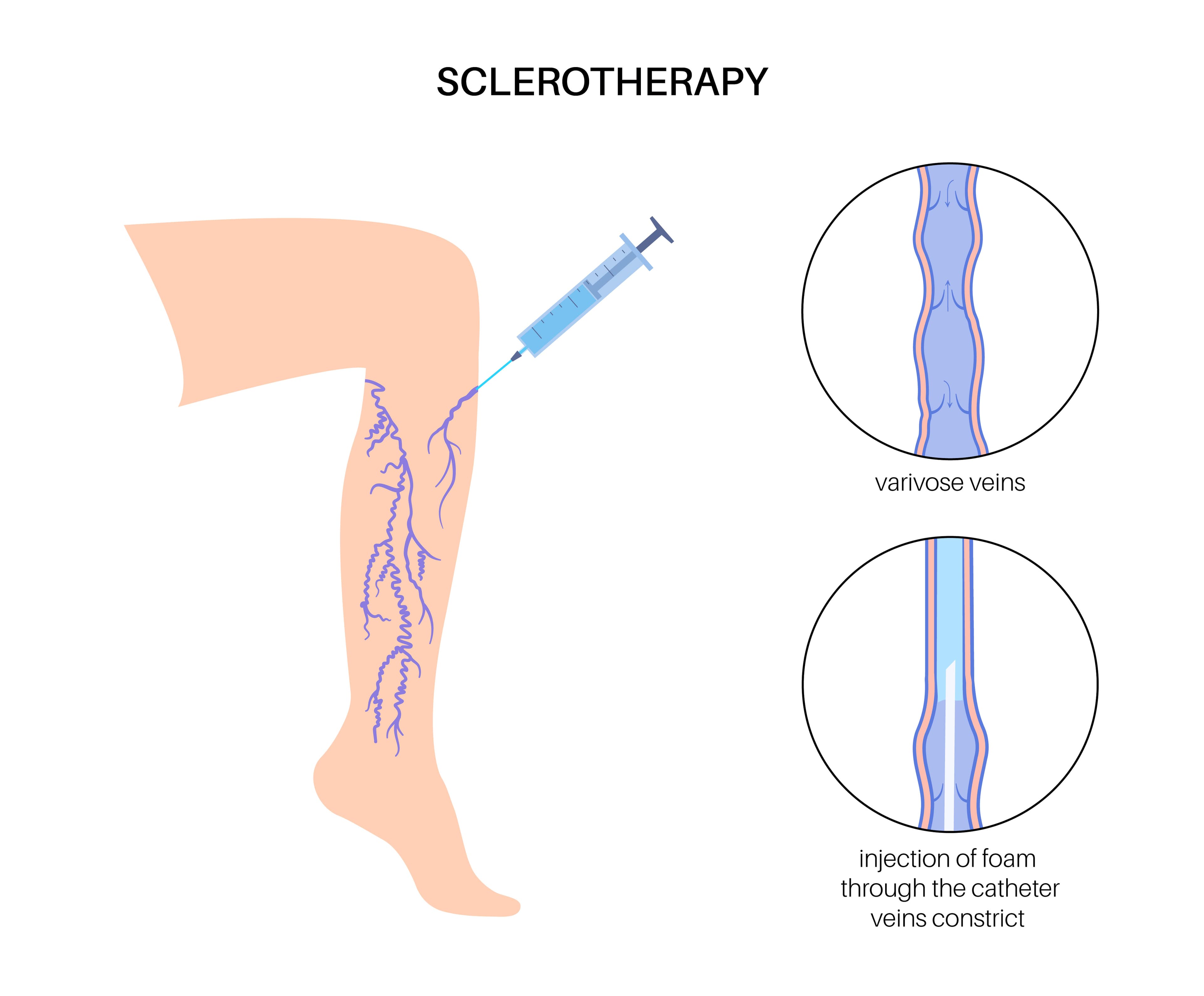Sclerotherapy treatment diagram