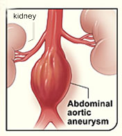 Illustration of an abdominal aortic aneurysm