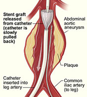 Illustration of an abdominal stent