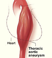 Illustration of an abdominal aortic aneurysm