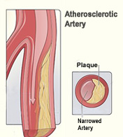 Illustration of Arterial Insufficiency