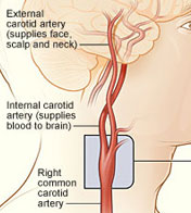 Illustration of the carotid arteries