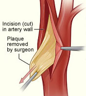 Illustration of plaque being removed from a carotid artery