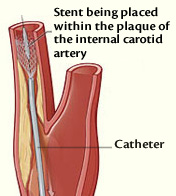Illustration of carotid artery stenting