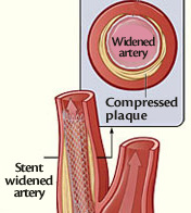 Illustration of carotid artery stenting