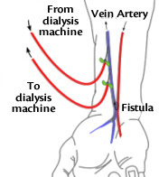 Illustration of Arterial Insufficiency