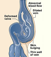 Illustration of Varicose Veins